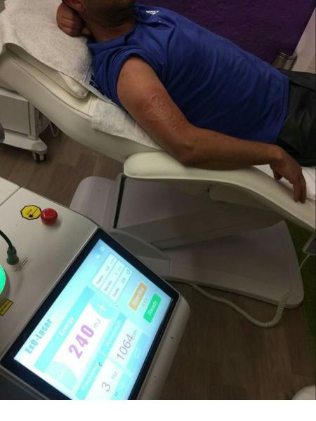 q switch nd yag laser Hyperpigmentation removal,Mongolian Spot Nd:YAG laser manufacturer