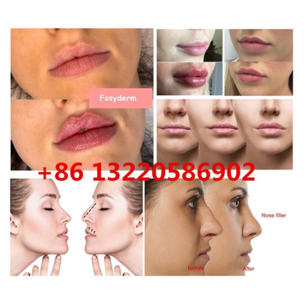 Juvederm ультра 3 Hyaluronic кисловочных губы дермальных заполнителя русских с Lidocaine