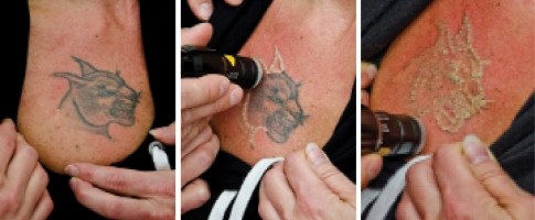 1064nm 532nm ND YAG Laser Tattoo Removal Machine Pigmentation Freckle Removal