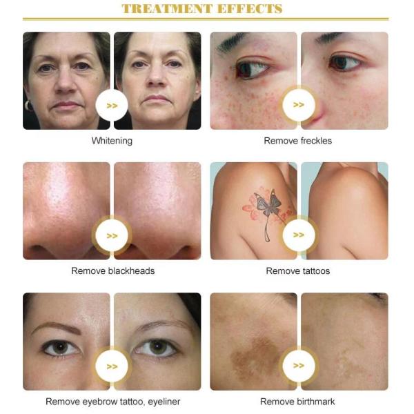 3 в 1 к переключил машину татуировки лазера НД Яг размер места 2 до 8мм