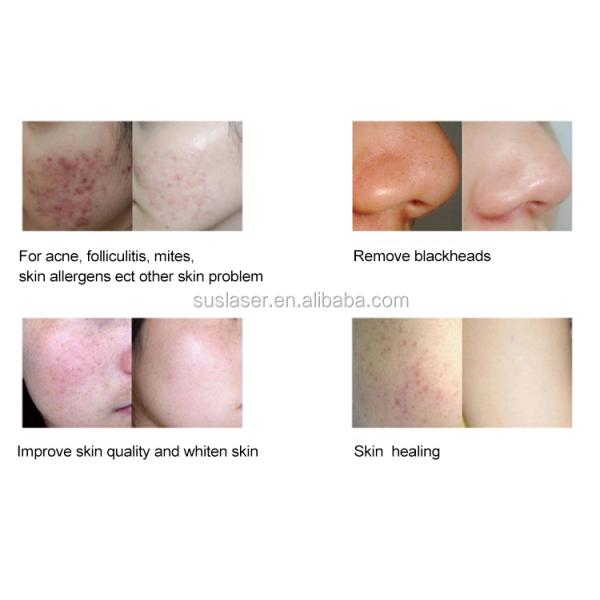 Portable 6 In 1 Hydro Dermabrasion Machine Multifunctional Facial Aqua Peeling Machine