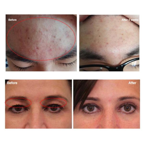 Aesthetic Skin Wrinkle Removal Machine / Plasma Lifting Rf Beauty Machine