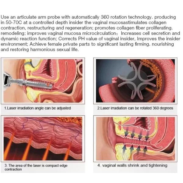 Continuous Interval Ultra Pulse RF Fractional CO2 Laser For Fractional Skin Resurfacing