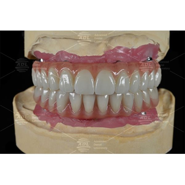 China Dental Lab Fast Turnaround Time In 72 Hours Provides High Quality All on X