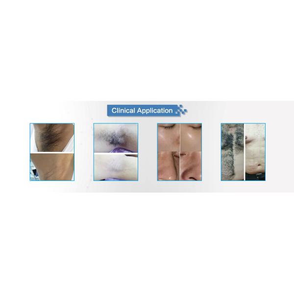 Professional OPT SHR Hair Removal Machine For Brown Skin Fast Speed 2500W