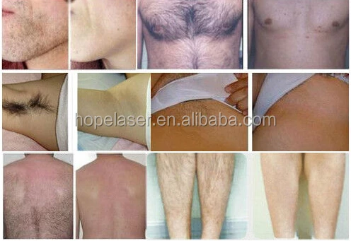2000W strong power ! Germany bar diode laser hair removal system/ three wavelength 808nm + 755nm + 1064nm