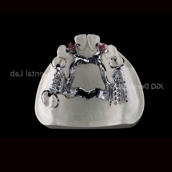 3D Printing Titanium Dental Framework for Customized Removable Dentures