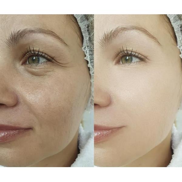 Piel del suero de Pdrn de la cara que blanquea la inyección para Hyaluron Pen Microneedles