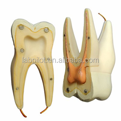 Modèle anatomique 16 fois amplifié de carie dentaire Modèle pour l'éducation et l'enseignement