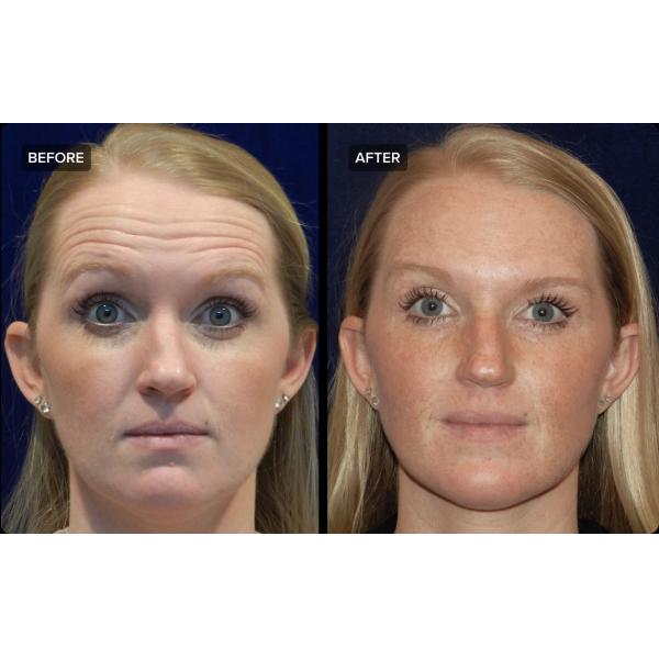 Анти- старея Ce Hyamely  100 Ui для морщинок