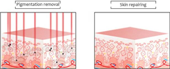 машина 2mm удаления татуировки лазера picocare 1-10Hz 3mm