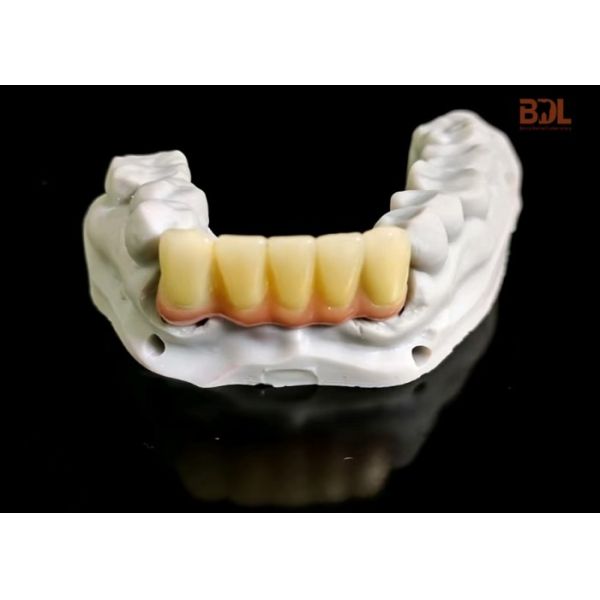 High Fracture Toughness Ceramic Dentures with High Translucency and Low Thermal Conductivity for Dental Restorations