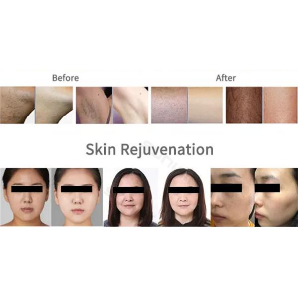 Профессиональный лазер 2 диода 808nm в 1 приборе удаления татуировки лазера пикосекунды удаления волос