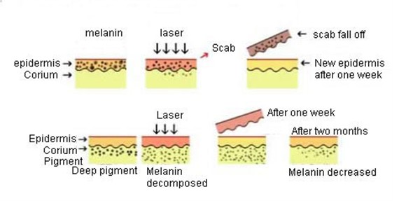 High Power Dark Age Spot Removal Q-Switched ND YAG Laser Machine 532nm / 1064nm