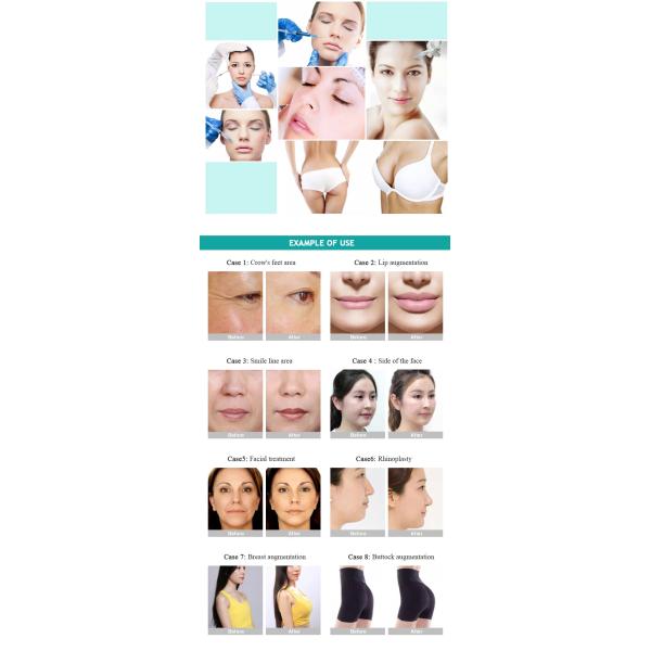 Рот Ха Гиалуроновая кислота Кожный наполнитель Гиалуроновая кислота для увеличения губ 2 мл