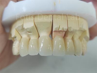 Dental Product Zirconia Layered With Porcelain Easy Maintenance