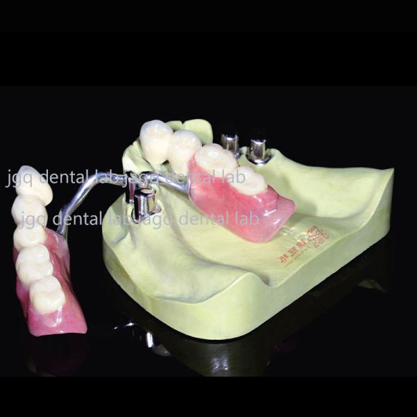 Telescope Dental Crowns High Precision Milled Precision Attachments With Acrylic Teeth Set Up