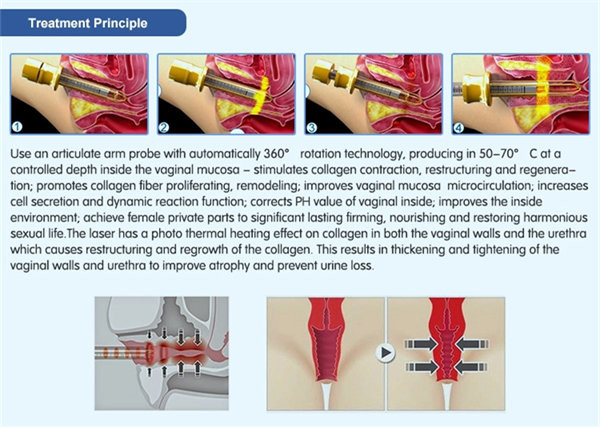 машина лазера СО2 ISO 635nm частичная, машина подмолаживания кожи 30W