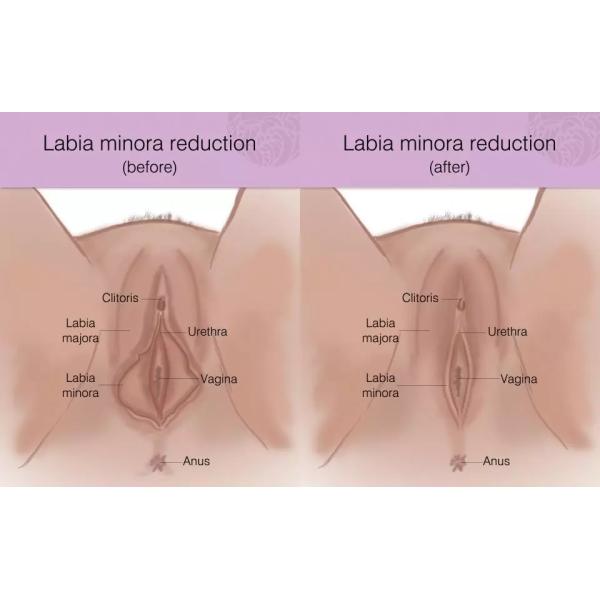 2 In 1 RF Beauty Machine for female intimate areal Tighten Labia Tighten Vulva Rejuvenation and Beauty