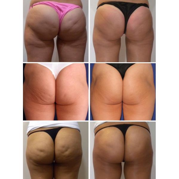 Терапия ударной волны машины обработки целлюлита уменьшая машину