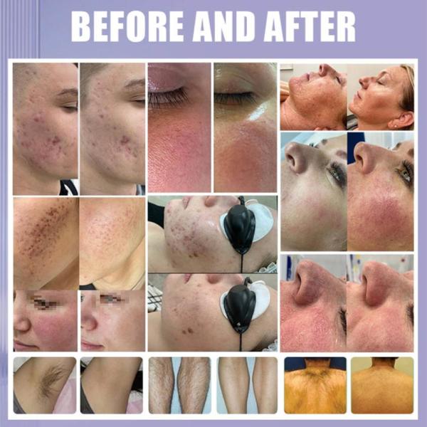 Машина удаления волос IPL салона и клиники