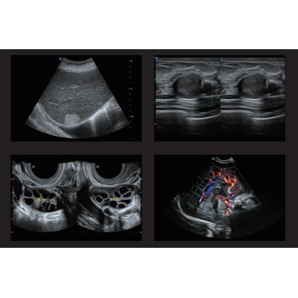 Sonoscape Portable Color Doppler Ultrasound Sonoscape S22 Ultrasound Machine Sonoscape P20 Doppler Ultrasound