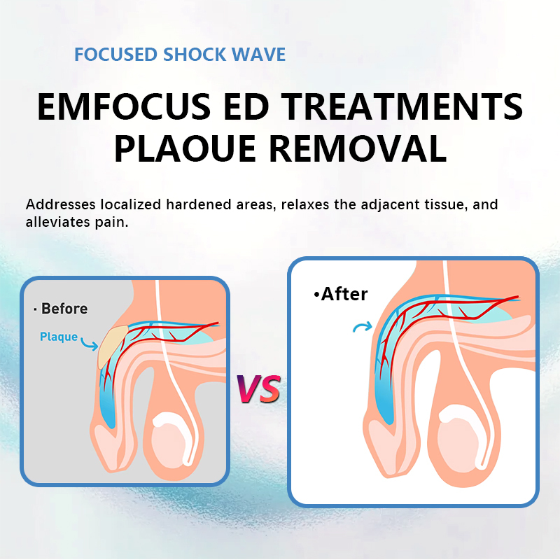 ESWT Extracorporeal Pain Relife Ed Treatment Focused Electromagnetic Shockwave Therapy Machine