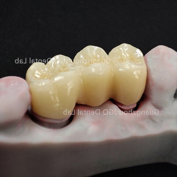 Custom Zirconia Restorations Professional Dental Lab for Global Dental Clinics