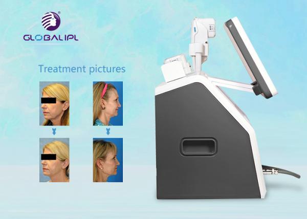 Portable HIFU Skin Rejuvenation Equipment Home Use Mini HIFU Ultrasound Machine