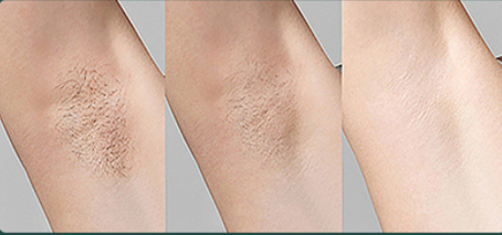 808nm Fast SHR Hair Removal Machine True Uk Lamp Permanent 1 Million Shots Life