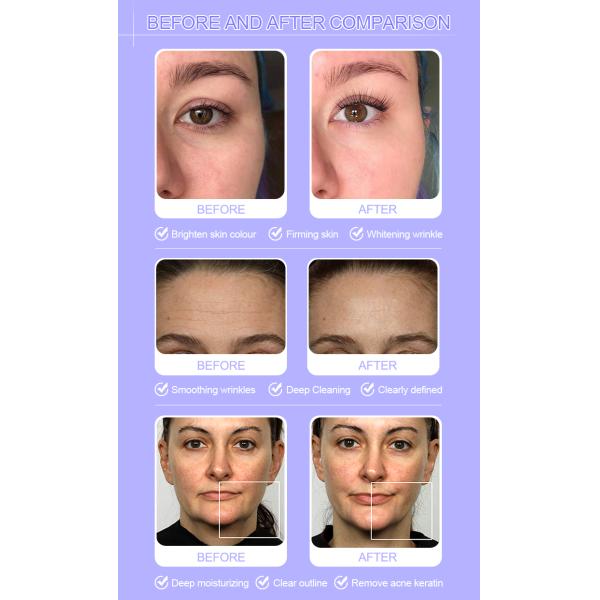 9 In 1 Hydra Dermabrasion Machine Professional Facial Cleaning Beauty Machine