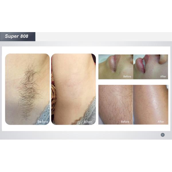 Машина 500W удаления волос лазера диода 800W боли свободная