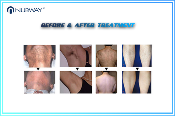 Hot sale Diode laser hair removal machine/ permanent and painfree