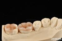 Restauración dental con apariencia natural