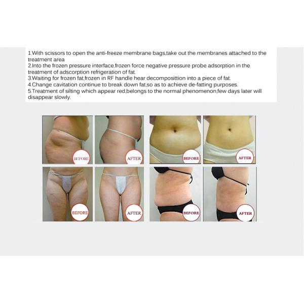 Body Sculpt Cryolipolyse Cryo Fat Freezing Machine For Cellulite Removal