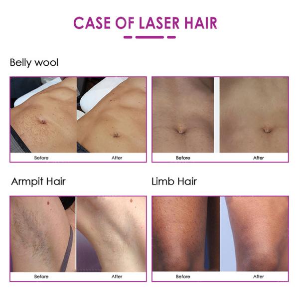 No Pain Portable Permanent Painless 755 808 1064 Hair Removal Laser Epilator 808Nm Diode Laser machine