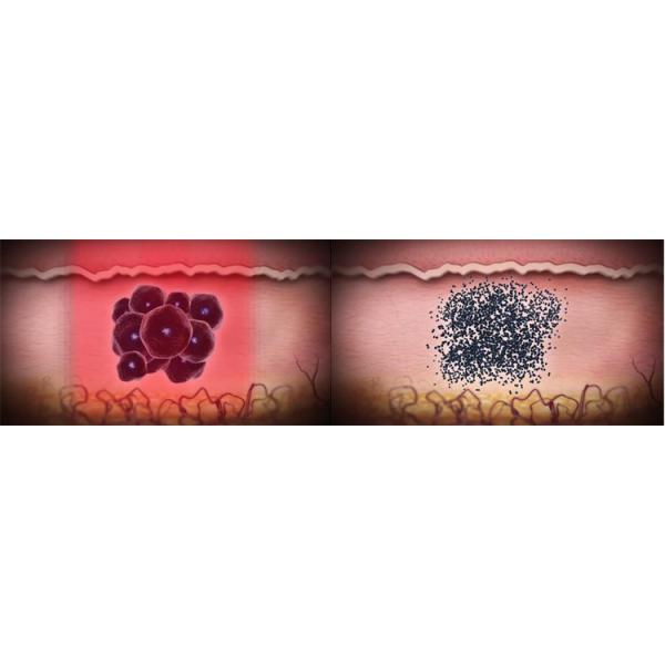 2000W q переключило машину корки углерода машины 1320nm лазера ND YAG