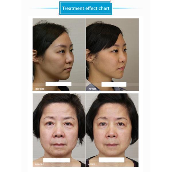 Portable Fractional 7d HiFu Beauty Machine RF Micro Needle Machine