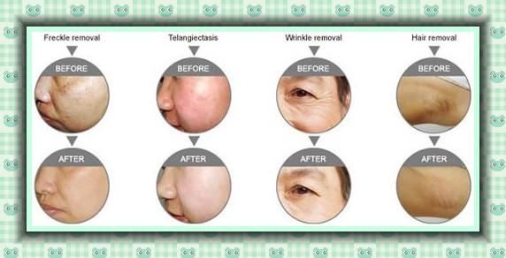 3000W Underarm SHR Hair Removal Machine Skin Rejuvenation / Acne Removal