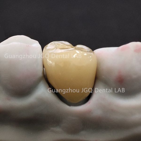 Dental Metal Ceramic Crown Pfm Bridge Artificial Teeth FDA CE Certificated