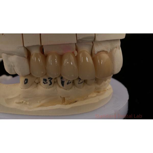 Noritake Porcelian Full Contour Zirconia Crown High Aesthetic Natural Customized Zirconia Dental Bridge