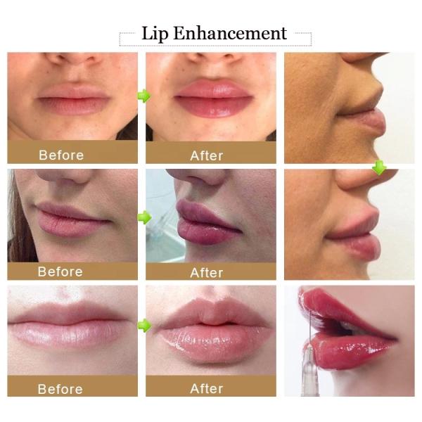 Experience The Power Of 20ml Hyaluronic Acid Dermal Filler For 9-12 Months Of Beauty