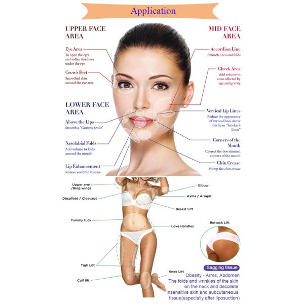 Cosmetic Absorbable Facial High Quality Pdo Thread Lift Korea