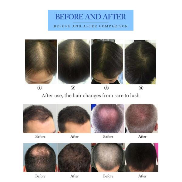 660nm Diode Laser Hair Growth Device For Hair Regeneration / Scalp Nourishment