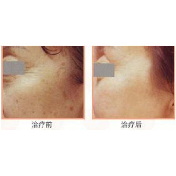 Professional Fractional Co2 Laser Machine For Head Hair Reborning OEM / ODM