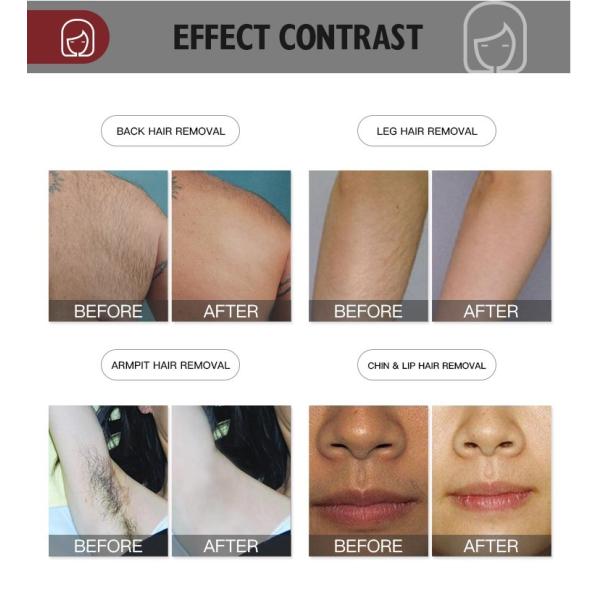 Магнитооптическая белизна машины 400W удаления волос лазера диода 755nm