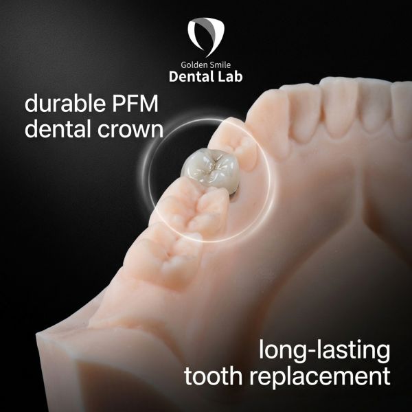 74% Yellow Gold Crown PFM High Noble Porcelain Fused To Metal Crown