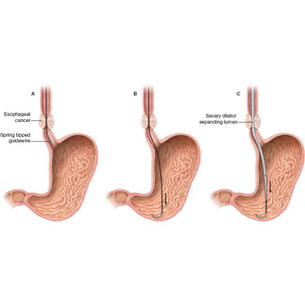 Набор расширителя Savary одиночной пользы медицинский медицинский для Esophagus