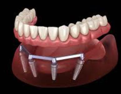 Sandblasted Denture Implant Bar For Translucent And Natural Esthetics