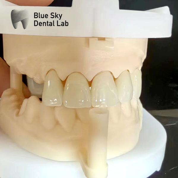 Coroas de zircón en capas de porcelana rosa Coroa dental de zircón para restauraciones estéticas